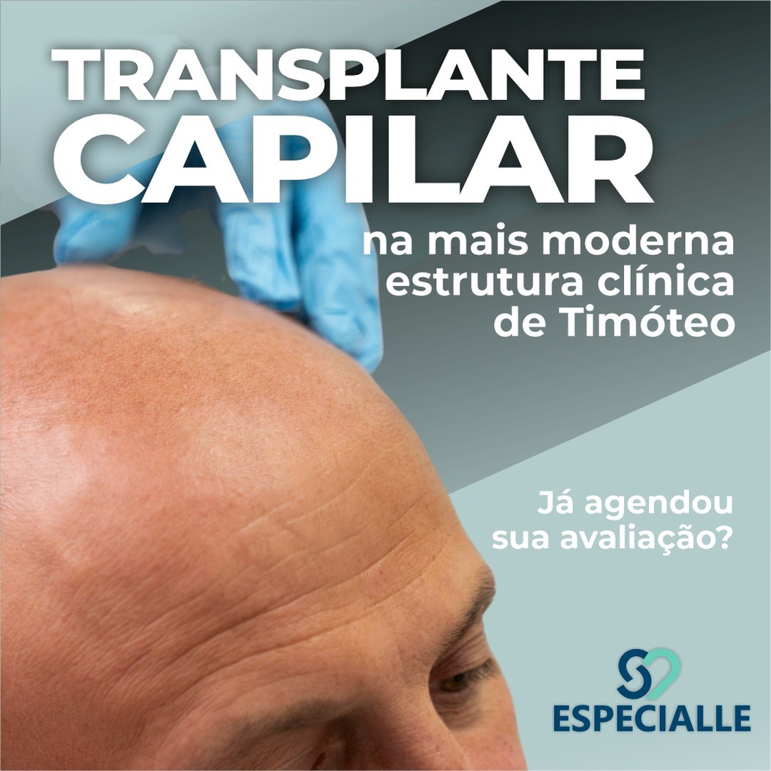 Transplante Capilar – na mais moderna estrutura clinica de Timóteo